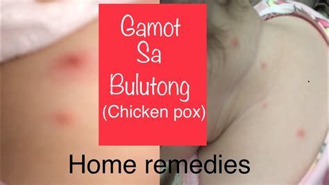 CHICKEN POX (Bulutong.